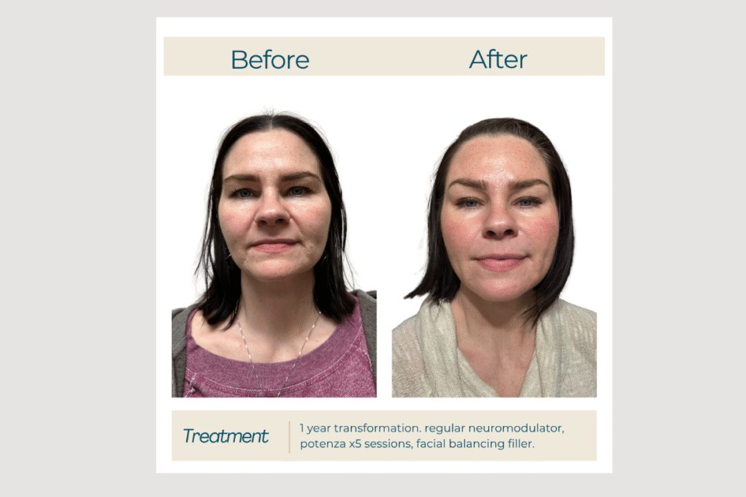 Potenza RF Microneedling