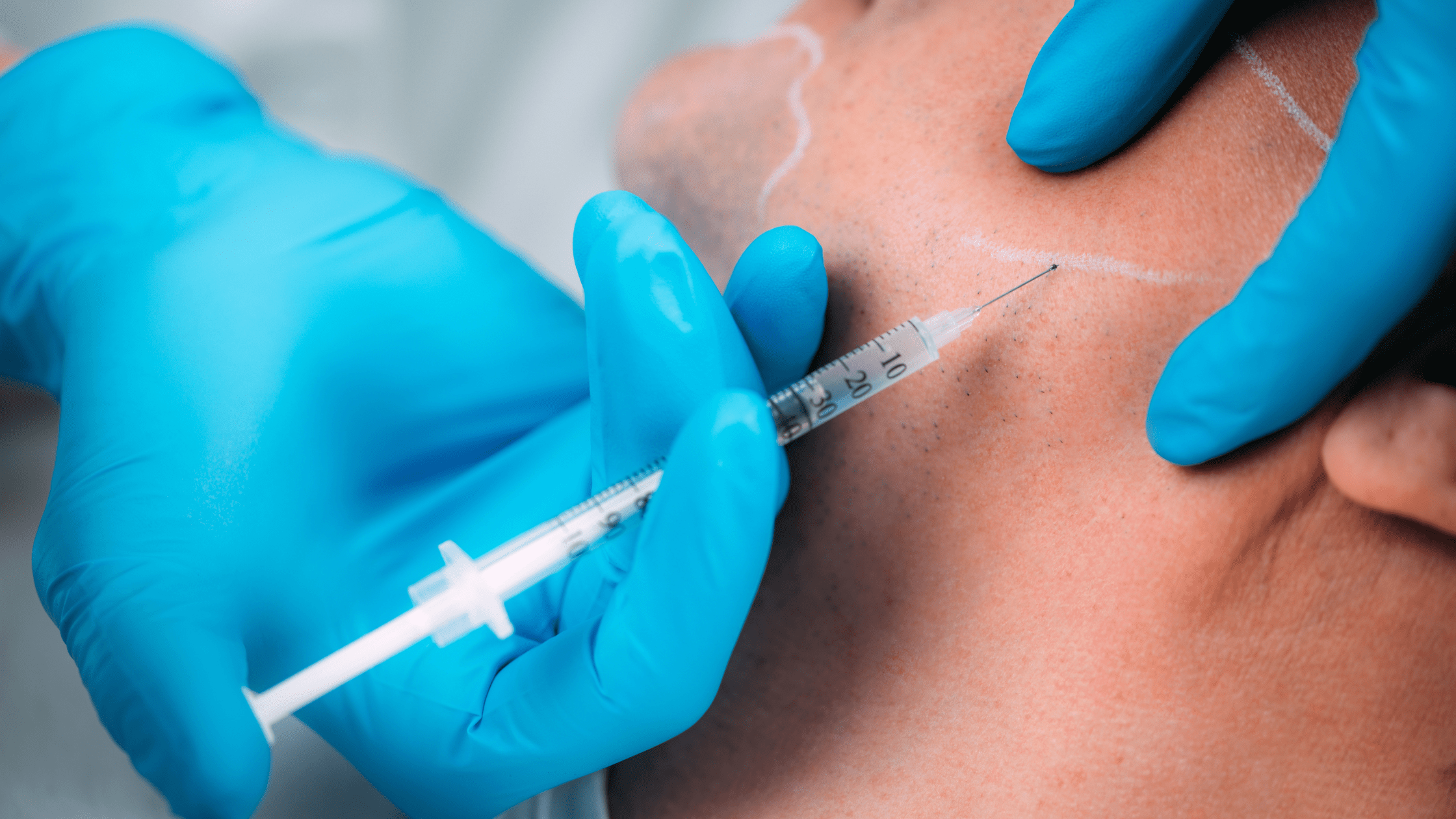 Sculptra® | Collagen Stimulator for Natural Volume - Image 4