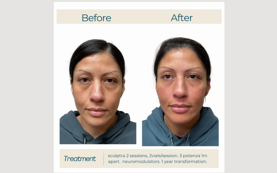 Sculptra for Midface Volume & Under-Eye Hollowness