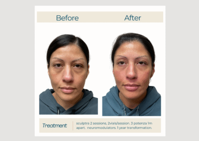 Sculptra for Midface Volume & Under-Eye Hollowness