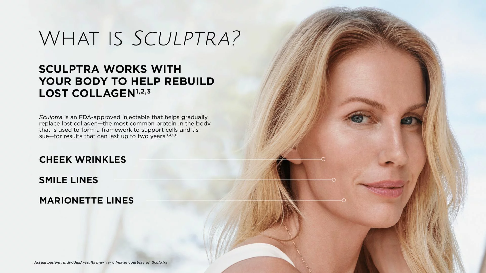 sculptra1 sculptra collagen building in anchorage ak