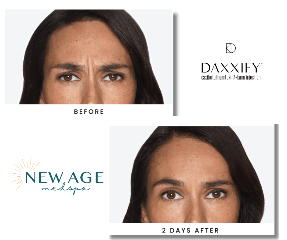 DAXXIFY before and after 2 days fast acting daxxify, 2 days results anchorage alaska neuromodulators for wrinkles