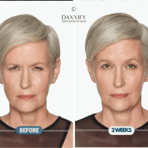 angry 11s daxxify treatment long lasting anchorage alaska new age medspa