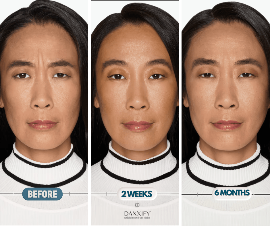 Daxxify before and after 6 months results at New Age Medspa Anchorage AK