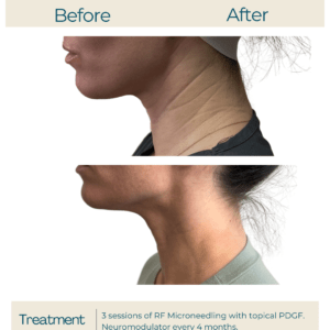 rf microneedling with pdgf