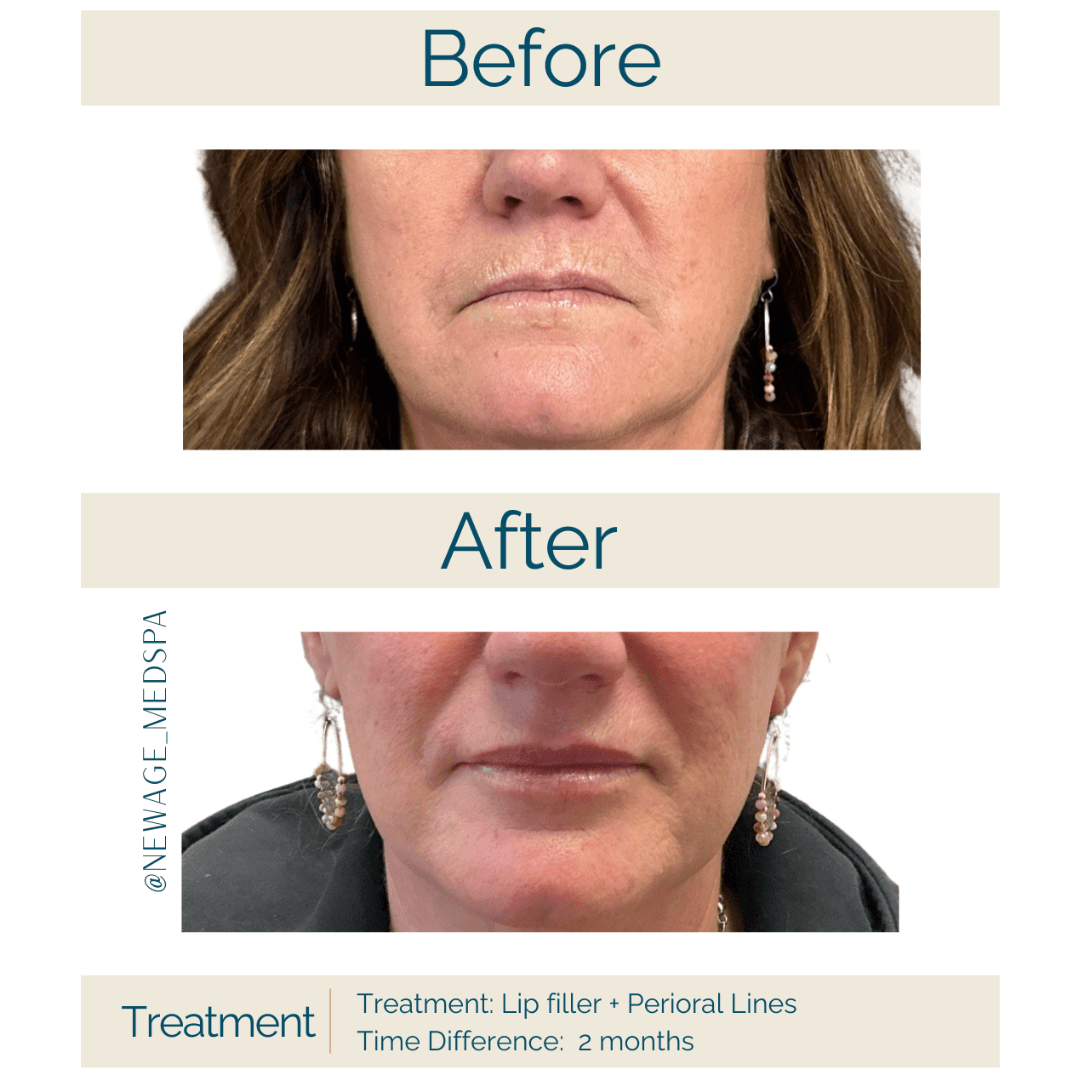 Lip filler before and after results at New Age MedSpa Anchorage