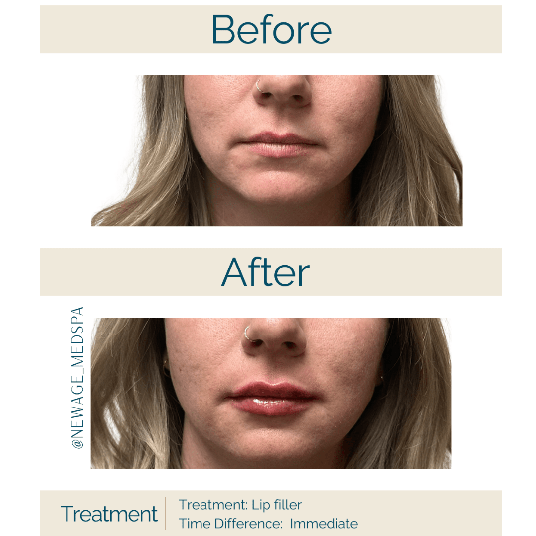 Lip filler immediately after treatment at New Age MedSpa Anchorage