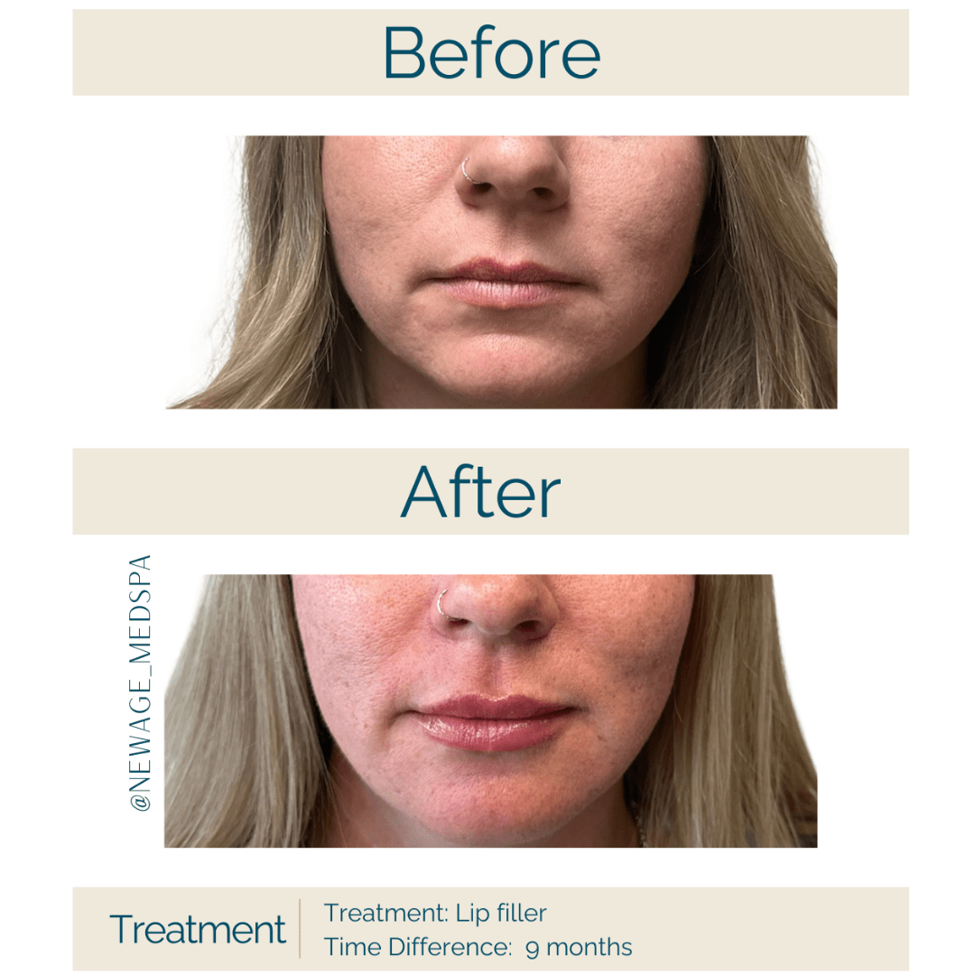 lip filler before and after in anchorage ak 