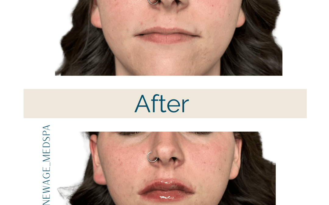 Lip Filler – One Syringe