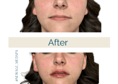 Lip Filler – One Syringe