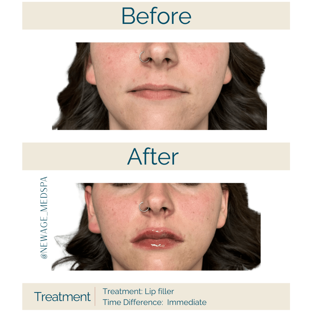 lip filler before and immediately after anchorage ak