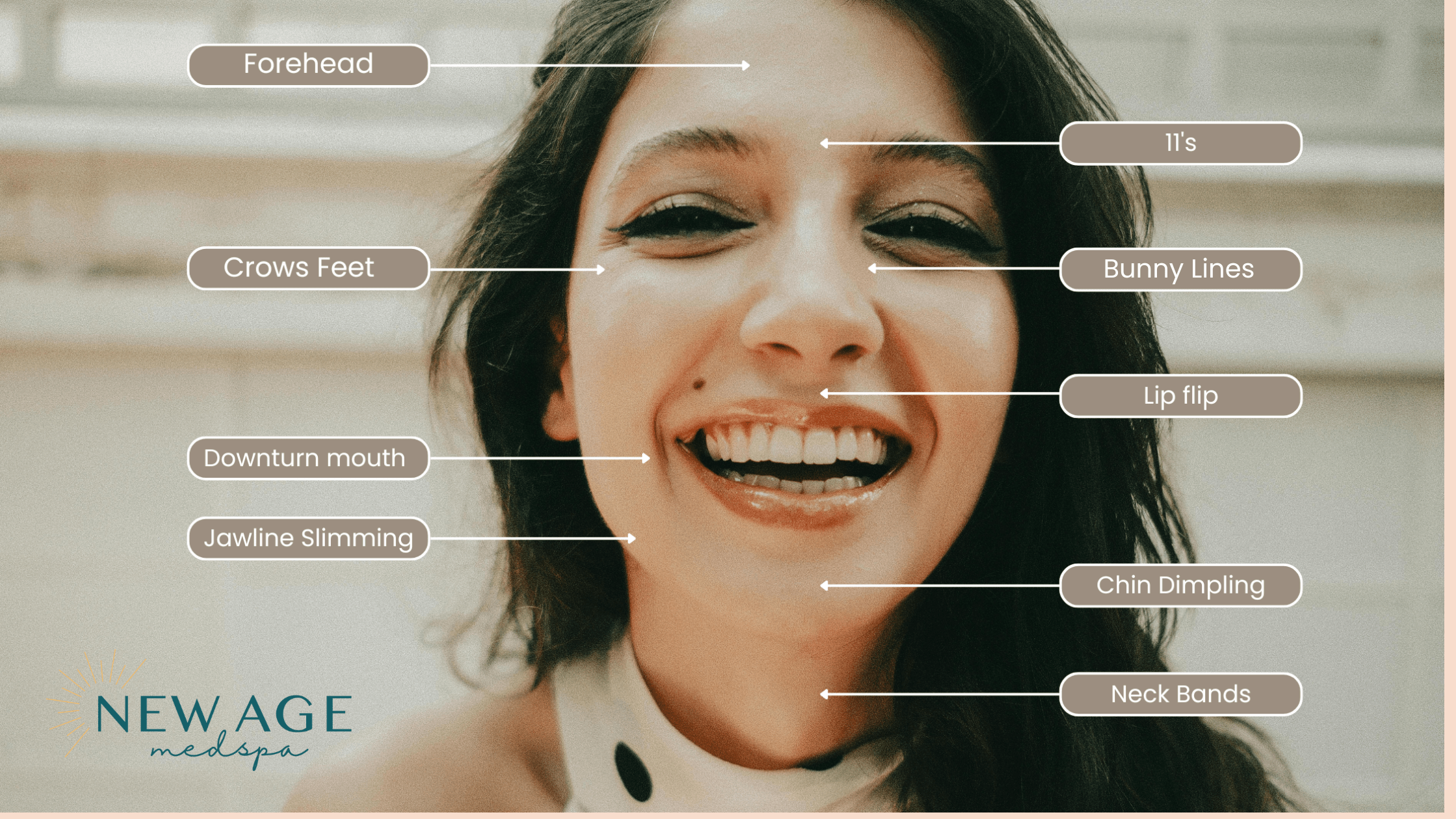 dysport location at new age medspa in achorage ak