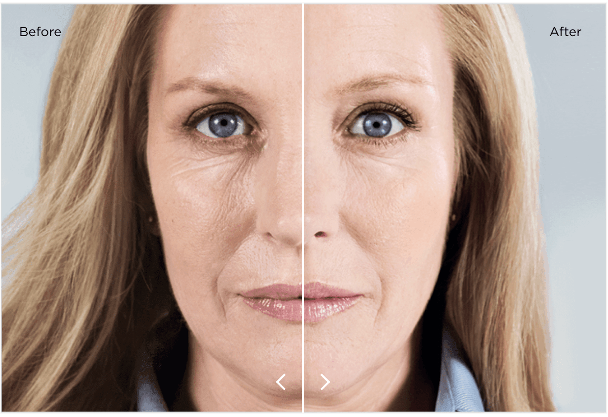 Sculptra before and after results — New Age Medspa Anchorage AK