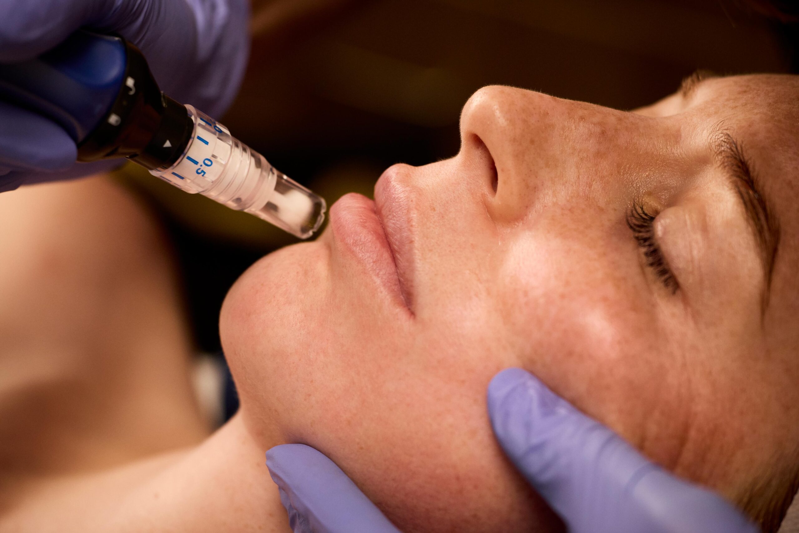 SkinPen Microneedling