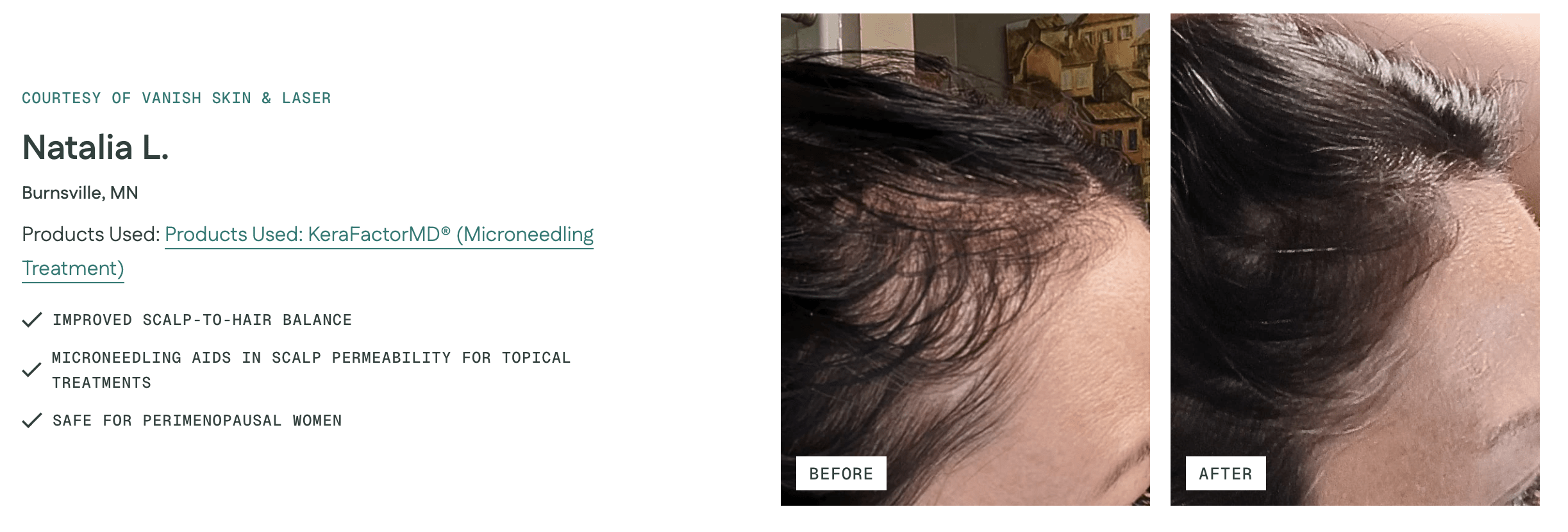 Before and after KeraLase and laser hair restoration treatment