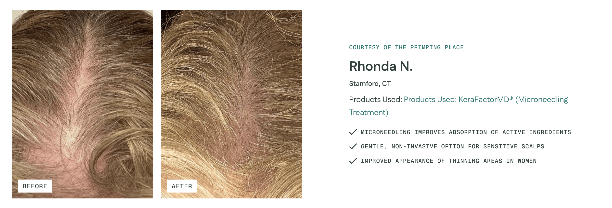 Before and after KeraLase laser hair restoration — female scalp showing increased hair density at New Age Medspa Anchorage