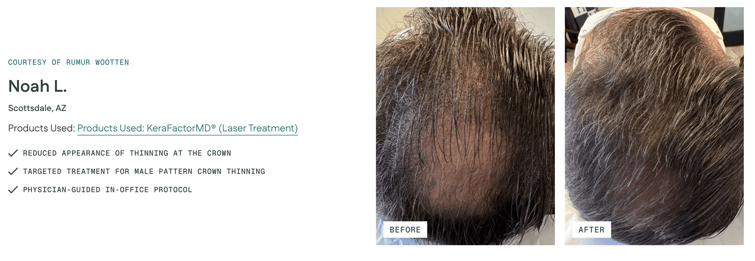 KeraLase laser hair restoration treatment being performed at New Age Medspa in Anchorage, Alaska