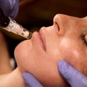 skin pen microneedling special october