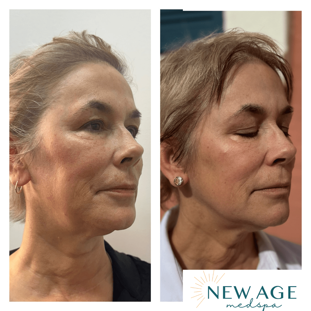 Before and after full facial balancing with dermal filler at New Age Medspa