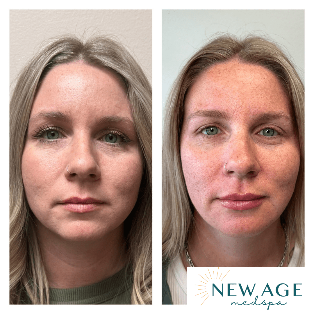 Before and after lip filler at New Age Medspa