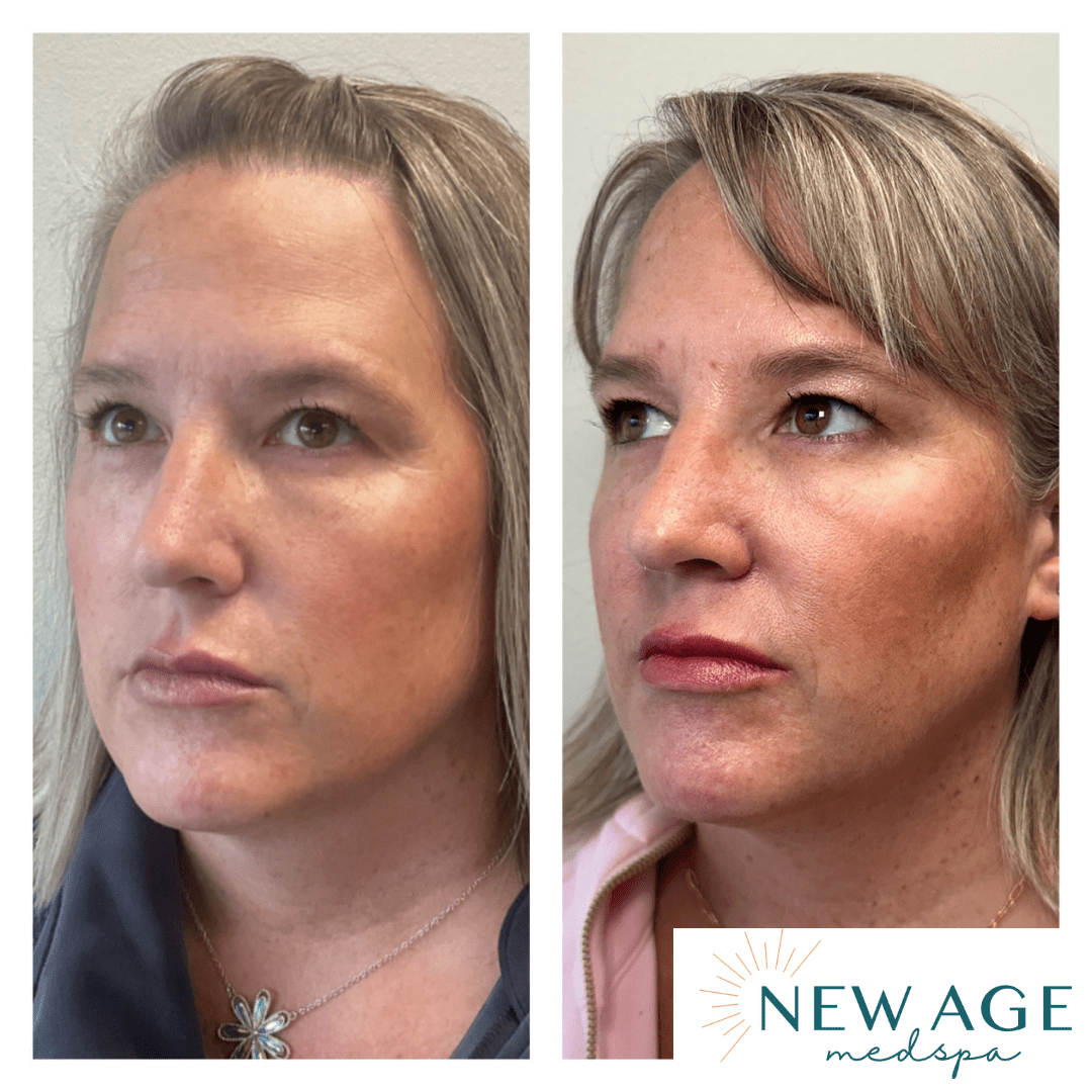 Before and after lip and cheek filler