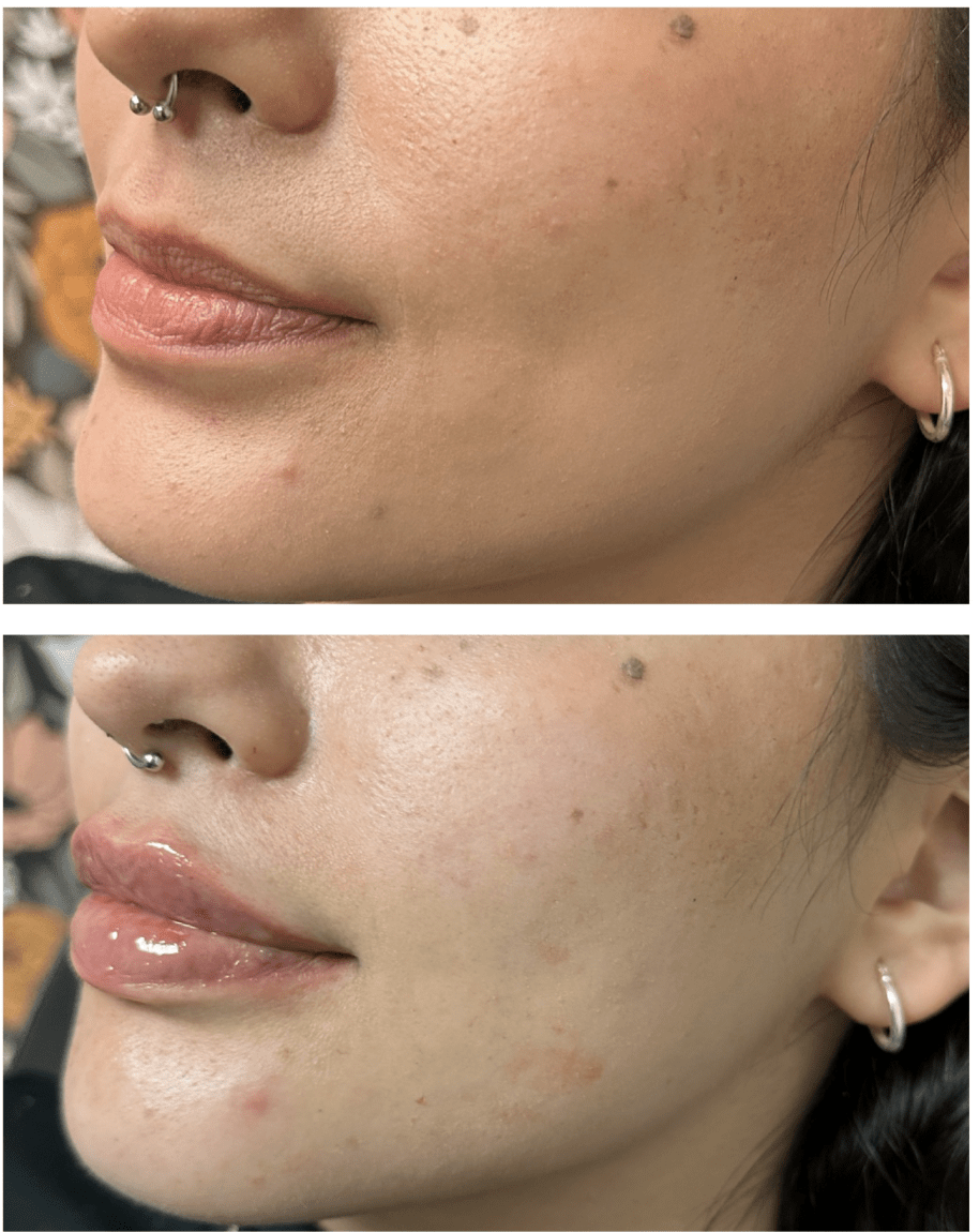 Before and after lip filler at New Age Medspa